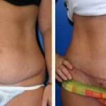 Tummy tuck and lipo before and after skin fold