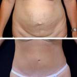 Tummy tuck and lipo before and after with hernia repair