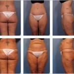 Tummy tuck before and after best pics
