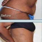 Tummy tuck before and after best surgeons pics