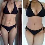 Tummy tuck before and after good pics