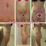 Tummy tuck before and after online pics