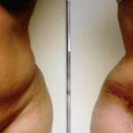 Tummy tuck before and after photos and pics