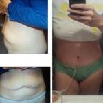 Tummy tuck before and after pics (1)