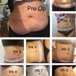 Tummy tuck before and after pics (2)