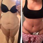 Tummy tuck before and after pics (4)