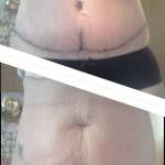 Tummy tuck before and after pics (6)