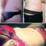 Tummy tuck before and after pics (7)