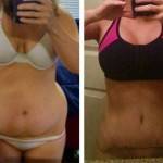 Tummy tuck before and after pics (9)