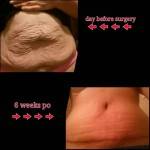 Tummy tuck before and after pics after massive weight loss