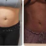 Tummy tuck before and after pics and images