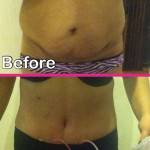 Tummy tuck before and after pics and photo