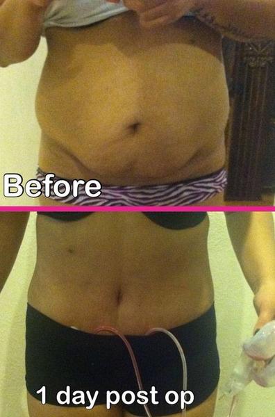 before and after tummy tuck in dominican republic