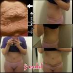 Tummy tuck before and after pics and photos