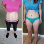 Tummy tuck before and after pics and picture