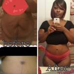 Tummy tuck before and after pics images