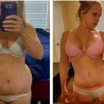 Tummy tuck before and after pics of best plastic surgeon