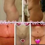 Tummy tuck before and after pics of best plastic surgeons