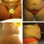 Tummy tuck before and after pics of best surgeon