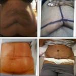 Tummy tuck before and after pics of good scars
