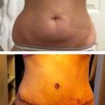 Tummy tuck before and after pics of patients