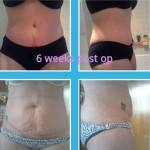 Tummy tuck before and after pics of real patients