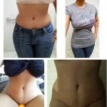 Tummy tuck before and after pics scar