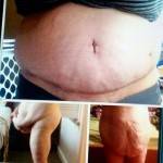 Tummy tuck before and after pics scars