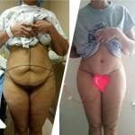 Tummy tuck before and after pics top