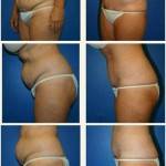 Tummy tuck before and after pics top plastic surgeons