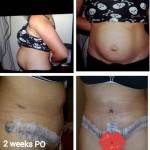 Tummy tuck before and after pictures and pics