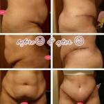 Tummy tuck before and after scars pics