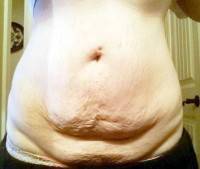 Tummy tuck before and after stretch marks image