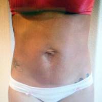Tummy tuck before and after stretch marks pictures