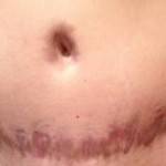 Tummy tuck belly button after weight loss pictures