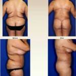 Tummy tuck belly button pictures before and after
