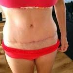 Tummy tuck ideal scars photos