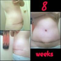 Tummy tuck incision problems image