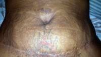 Tummy tuck incisions low