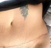 Tummy tuck incisions low scar