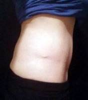 does a tummy tuck include love handles