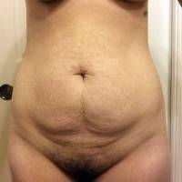 Tummy tuck love handles how to remove