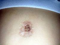 Tummy tuck new belly button photo