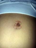 Tummy tuck new belly button picture