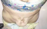 Tummy tuck no muscle repair picture