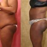 Tummy tuck operation before and after pics