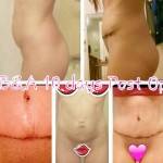 Tummy tuck operation pictures before and after