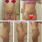 Tummy tuck operation pictures before and after gallery