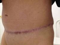 Tummy tuck or abdominoplasty picture after