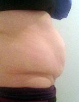 Tummy tuck or liposuction after pregnancy image